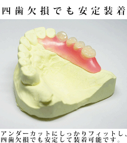 四歯欠損でも安定